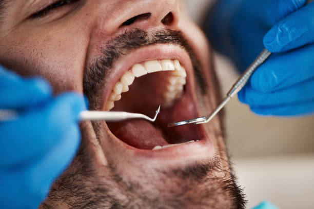 Best Emergency Wisdom Teeth Removal in Marine City, MI